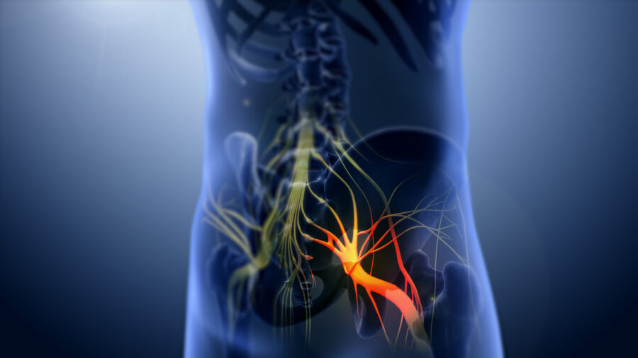 Sciatica, a pain in the butt!
